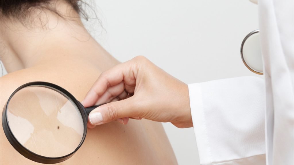 Unifacisa e HELP realizam mutirão de Prevenção ao Câncer de Pele com exames gratuitos